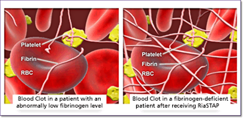 Blood clot in fibrinogen-deficient patient before and after receiving RiaSTAP